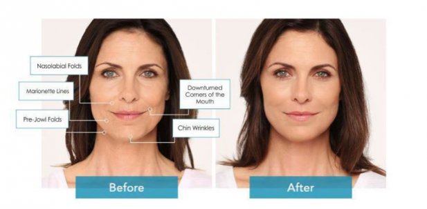 Top Dermal Fillers, Face and Neck Contouring, and Radio Frequency Skin Tightening Solutions Article - ArticleTed -  News and Articles