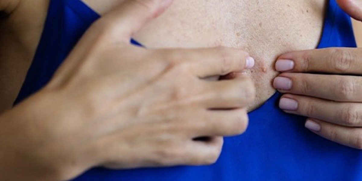 When Pimples on Your Breast Might Be a Health Concern